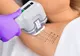Tratamentul hiperhidrozei cu botox